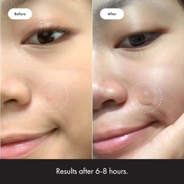Mighty Patch™ Original patch from Hero Cosmetics - Hydrocolloid Acne Pimple Patch for Covering Zits and Blemishes - Image 3